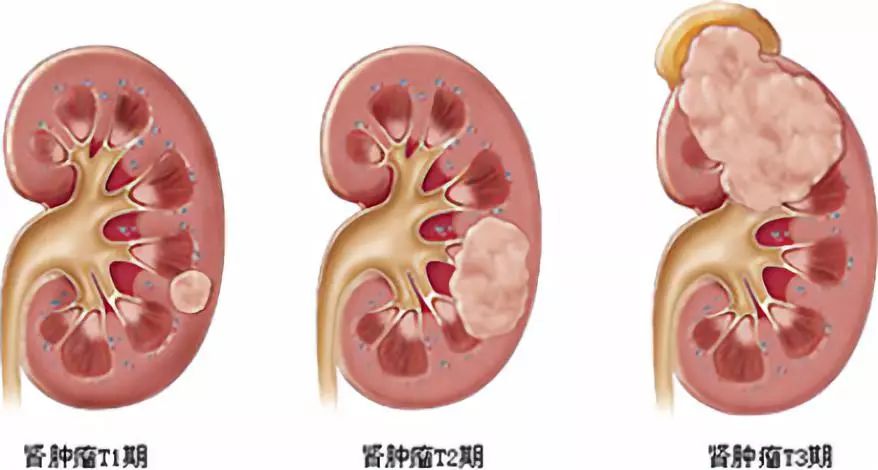 女性咽喉癌的早期癥狀圖片,關(guān)于女性咽喉癌的早期癥狀圖片及專業(yè)解答的問題,清晰計(jì)劃執(zhí)行輔導(dǎo)_冒險款33.14.39