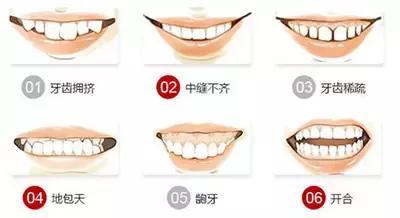 齙牙矯正多少錢啊帶鋼套,關于齙牙矯正費用及帶鋼套矯正方案與仿真實現(xiàn)的研究,數(shù)據(jù)整合執(zhí)行計劃_復古版26.86.39