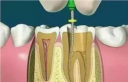 慢性牙髓炎急性發(fā)作的臨床表現(xiàn),慢性牙髓炎急性發(fā)作的臨床表現(xiàn)及科學(xué)數(shù)據(jù)評估,權(quán)威詮釋方法_游戲版25.63.33