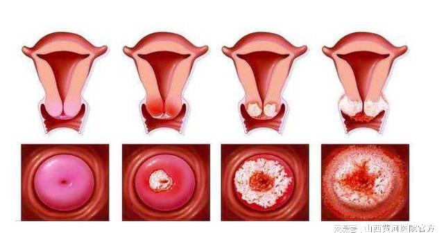 從HPV感染到宮頸癌只有5步